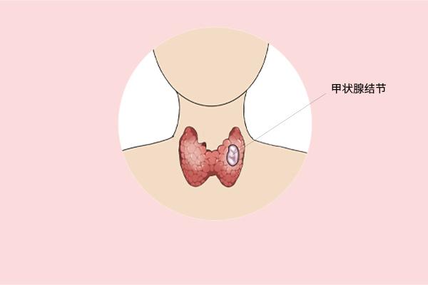 甲狀腺癌癥的主要癥狀表現(xiàn)有什么？為什么會得甲狀腺癌癥呢？