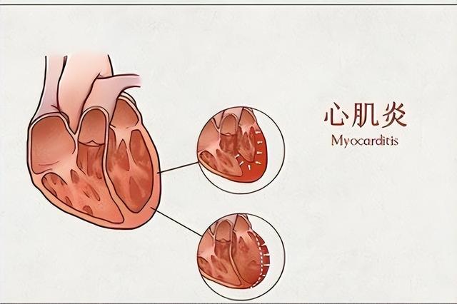 心肌炎的癥狀有哪些？心肌炎的主要變現(xiàn)癥狀有啥？